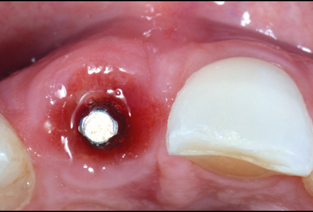 cerabone® and mucoderm® for immediacy in esthetic zone -Dr. M Motta