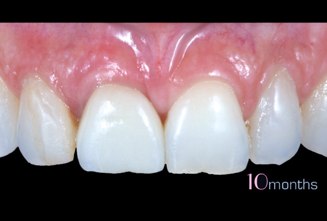 cerabone® and mucoderm® for immediacy in esthetic zone -Dr. M Motta
