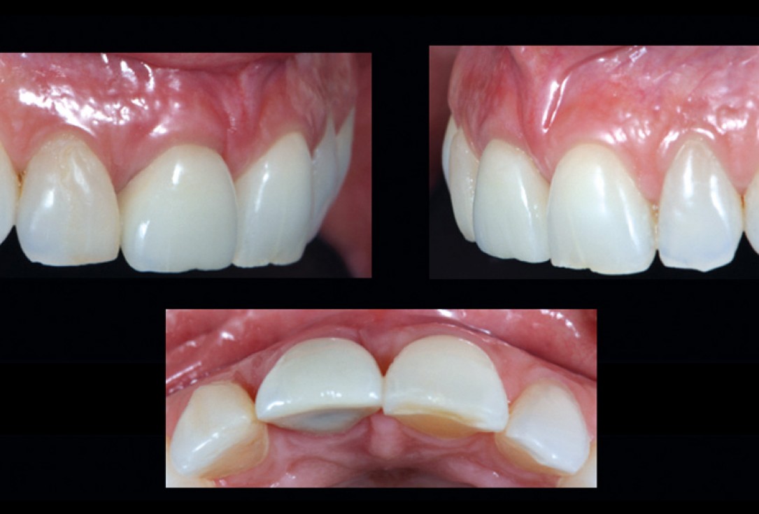 cerabone® and mucoderm® for immediacy in esthetic zone -Dr. M Motta