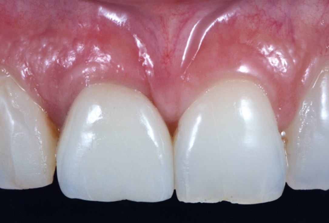 cerabone® and mucoderm® for immediacy in esthetic zone -Dr. M Motta