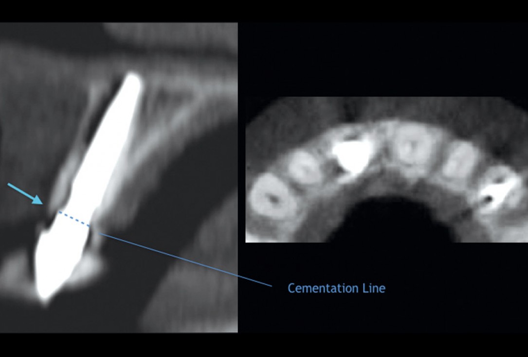 cerabone® and mucoderm® for immediacy in esthetic zone -Dr. M Motta
