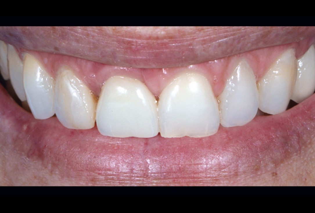 cerabone® and mucoderm® for immediacy in esthetic zone -Dr. M Motta