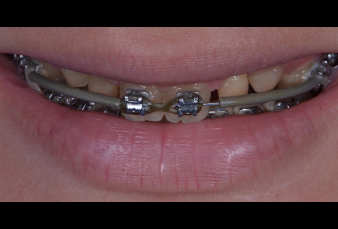 cerabone® and Jason® membrane for immediacy -Dr. M Motta