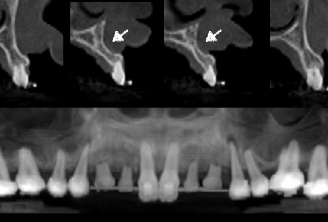 cerabone® and Jason® membrane for immediacy -Dr. M Motta