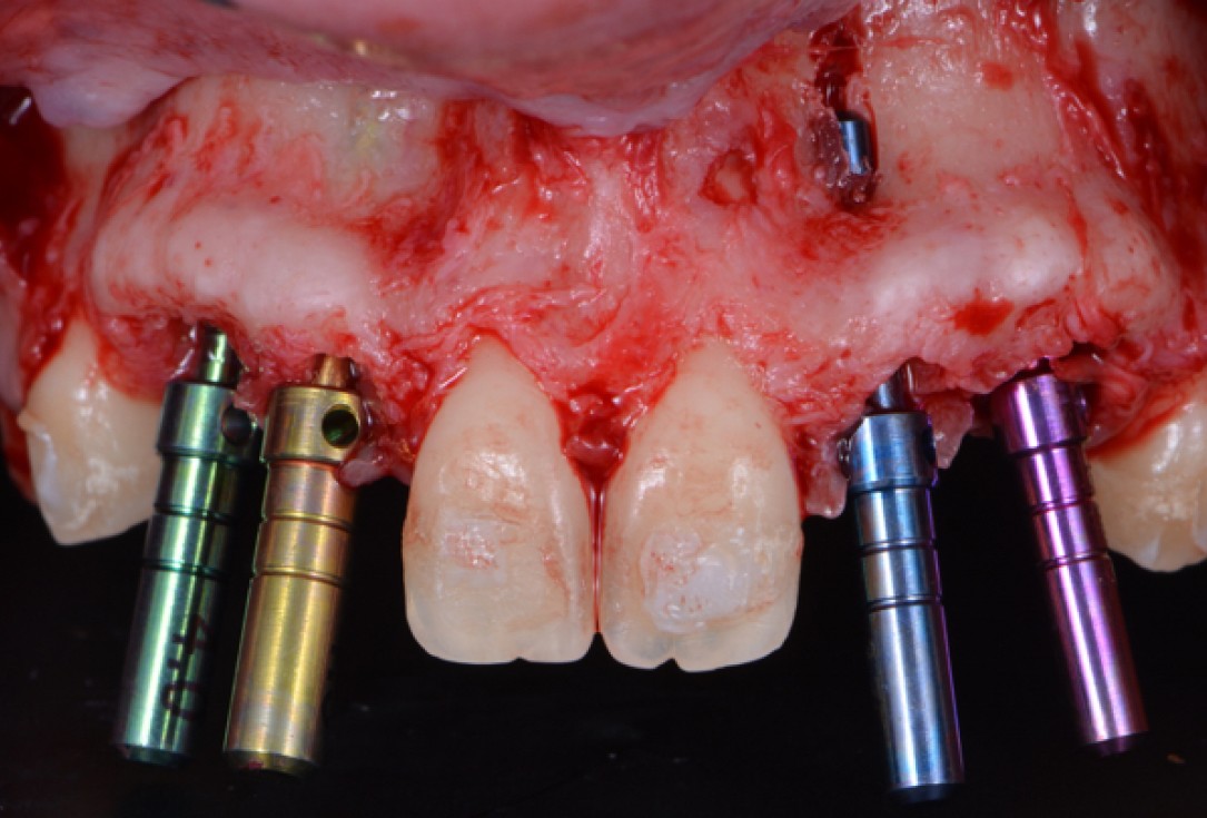 cerabone® and Jason® membrane for immediacy -Dr. M Motta