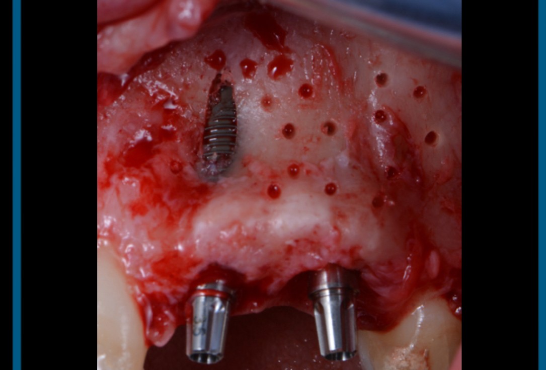 cerabone® and Jason® membrane for immediacy -Dr. M Motta