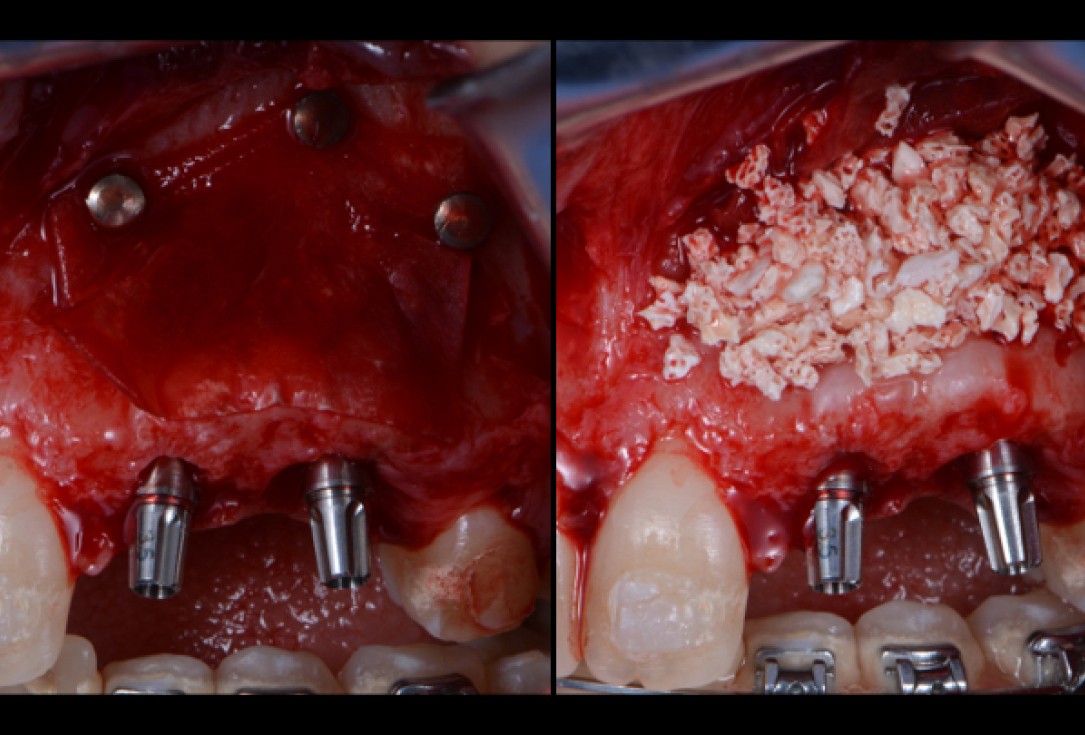 cerabone® and Jason® membrane for immediacy -Dr. M Motta