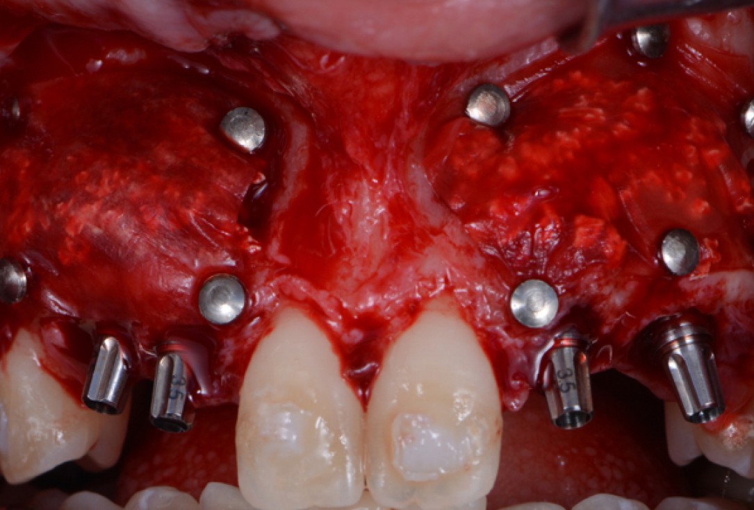 cerabone® and Jason® membrane for immediacy -Dr. M Motta