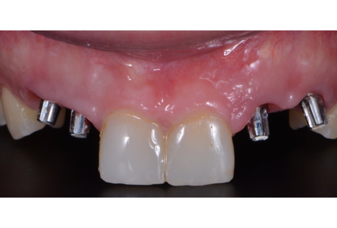 cerabone® and Jason® membrane for immediacy -Dr. M Motta