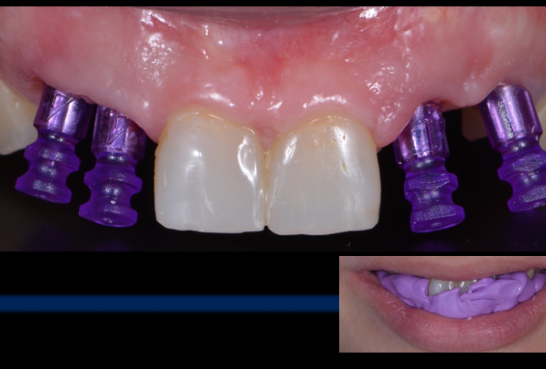 cerabone® and Jason® membrane for immediacy -Dr. M Motta