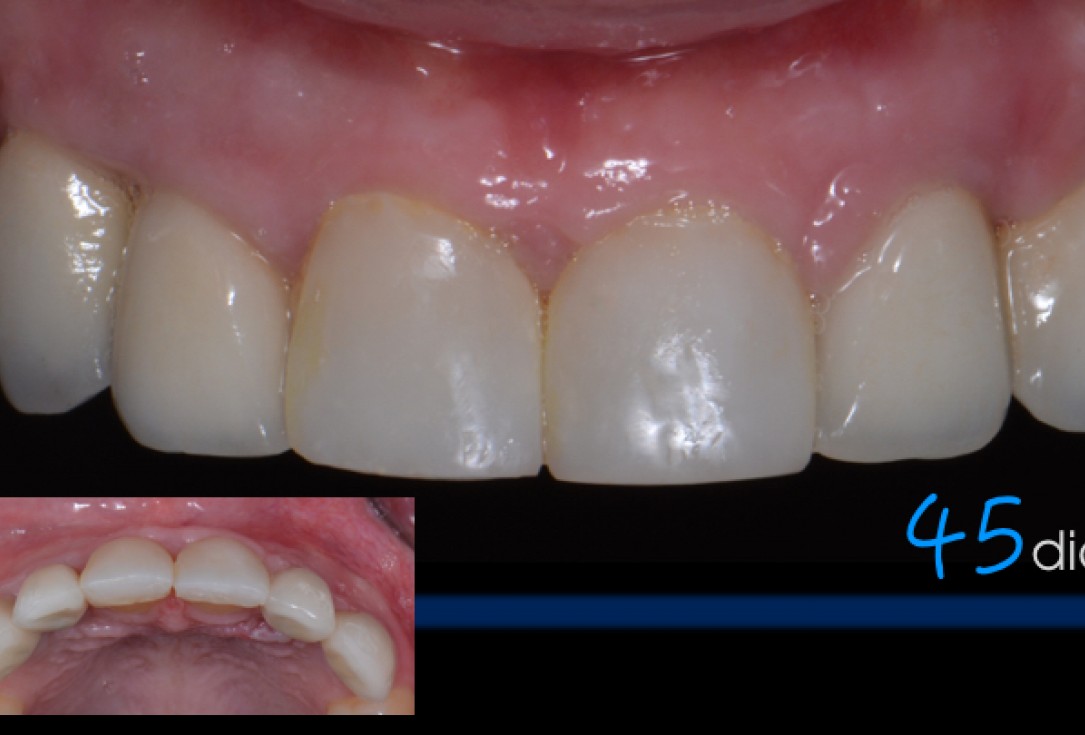 cerabone® and Jason® membrane for immediacy -Dr. M Motta