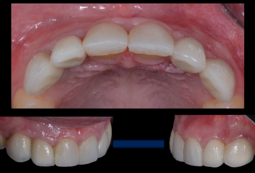 cerabone® and Jason® membrane for immediacy -Dr. M Motta