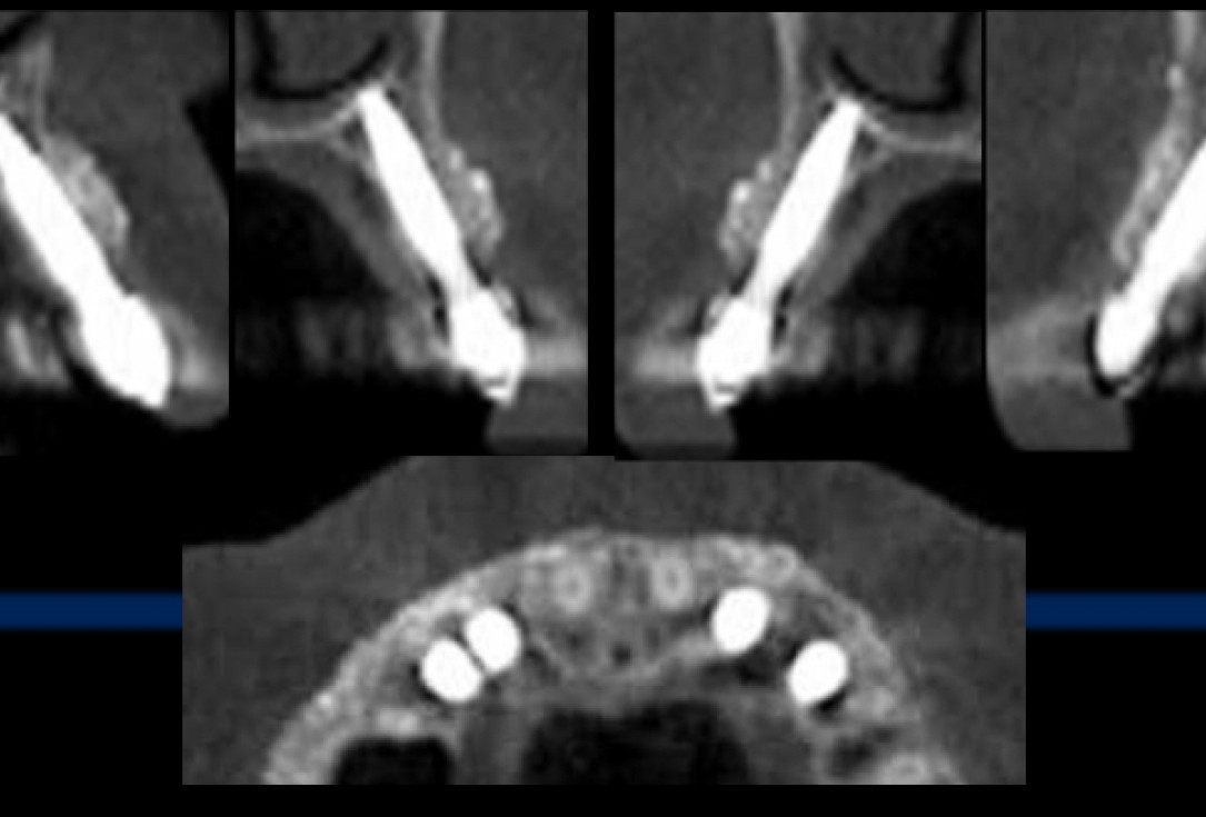 cerabone® and Jason® membrane for immediacy -Dr. M Motta