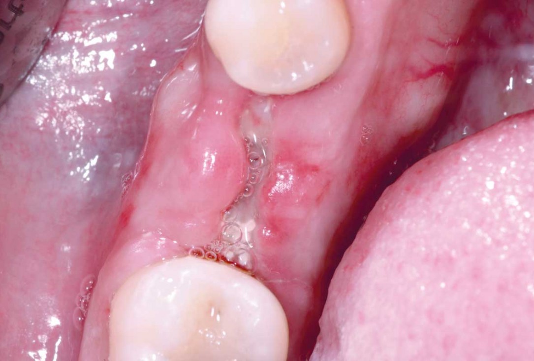 botiss cerabone plus for immediate implant placement and peri-implant bone augmentation - clinical case by Dr. R. Block Veras