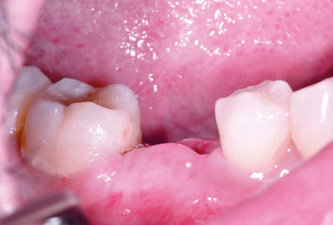 botiss cerabone plus for immediate implant placement and peri-implant bone augmentation - clinical case by Dr. R. Block Veras