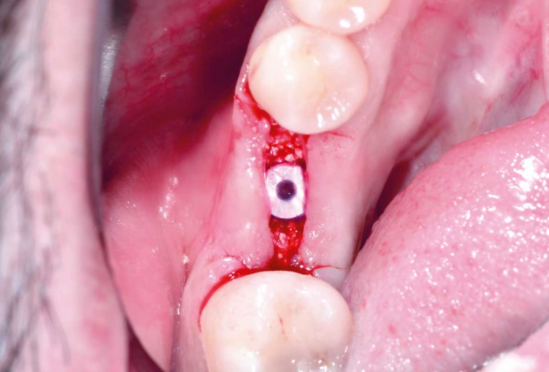 botiss cerabone plus for immediate implant placement and peri-implant bone augmentation - clinical case by Dr. R. Block Veras