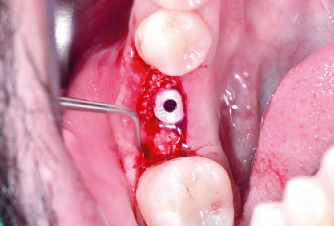 botiss cerabone plus for immediate implant placement and peri-implant bone augmentation - clinical case by Dr. R. Block Veras