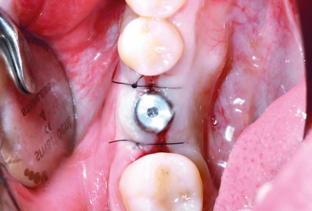 botiss cerabone plus for immediate implant placement and peri-implant bone augmentation - clinical case by Dr. R. Block Veras