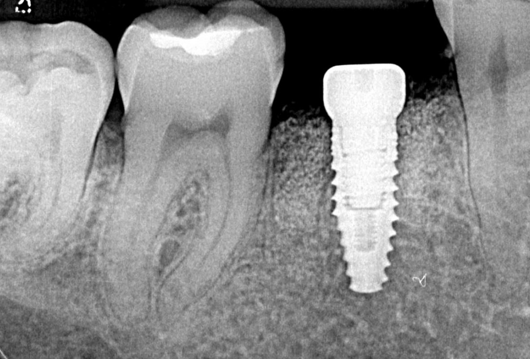 botiss cerabone plus for immediate implant placement and peri-implant bone augmentation - clinical case by Dr. R. Block Veras