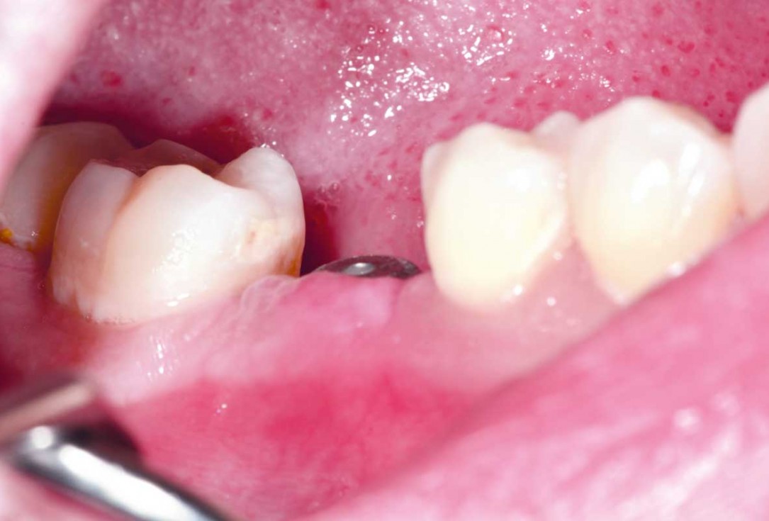 botiss cerabone plus for immediate implant placement and peri-implant bone augmentation - clinical case by Dr. R. Block Veras