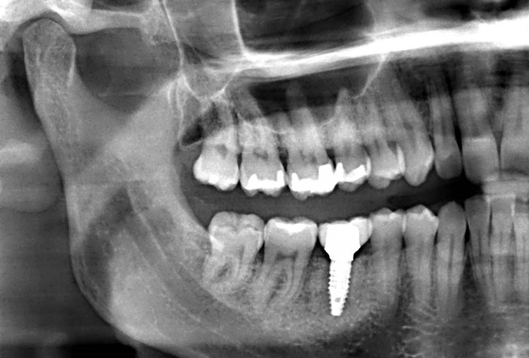 botiss cerabone plus for immediate implant placement and peri-implant bone augmentation - clinical case by Dr. R. Block Veras