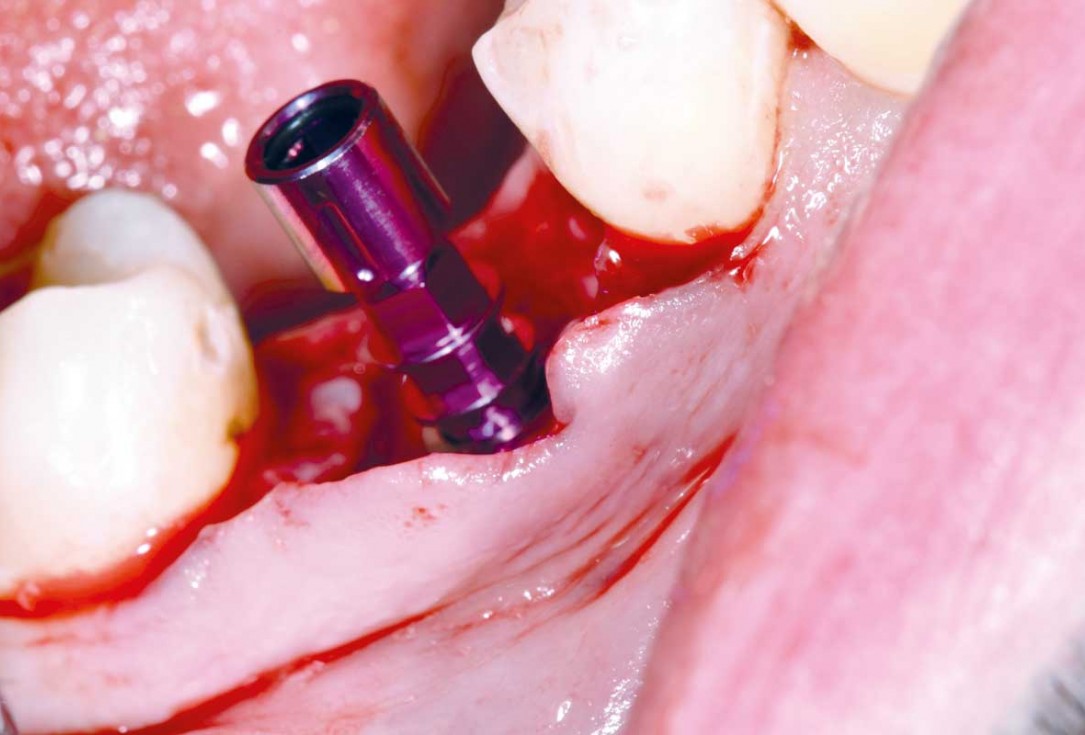 botiss cerabone plus for immediate implant placement and peri-implant bone augmentation - clinical case by Dr. R. Block Veras