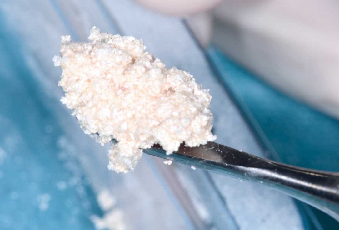 botiss cerabone plus for immediate implant placement and peri-implant bone augmentation - clinical case by Dr. R. Block Veras