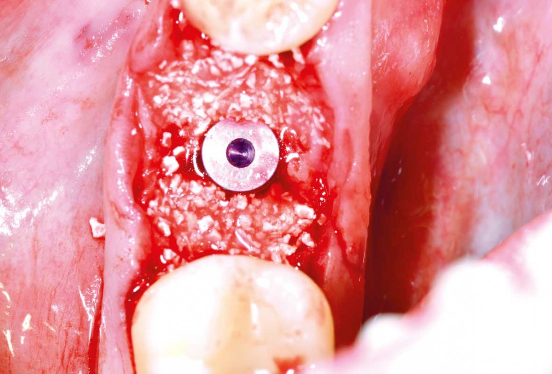 botiss cerabone plus for immediate implant placement and peri-implant bone augmentation - clinical case by Dr. R. Block Veras