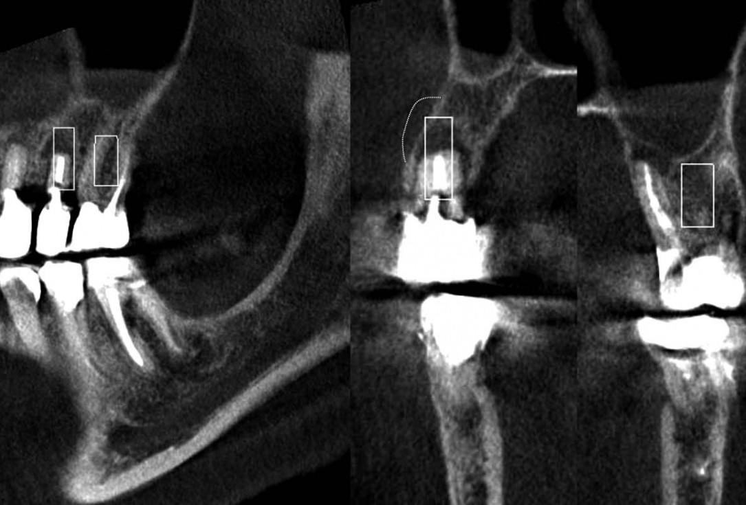 GBR and widening of the keratinized mucosa with mucoderm® - Clinical Case by Dr. M. Blaskovic