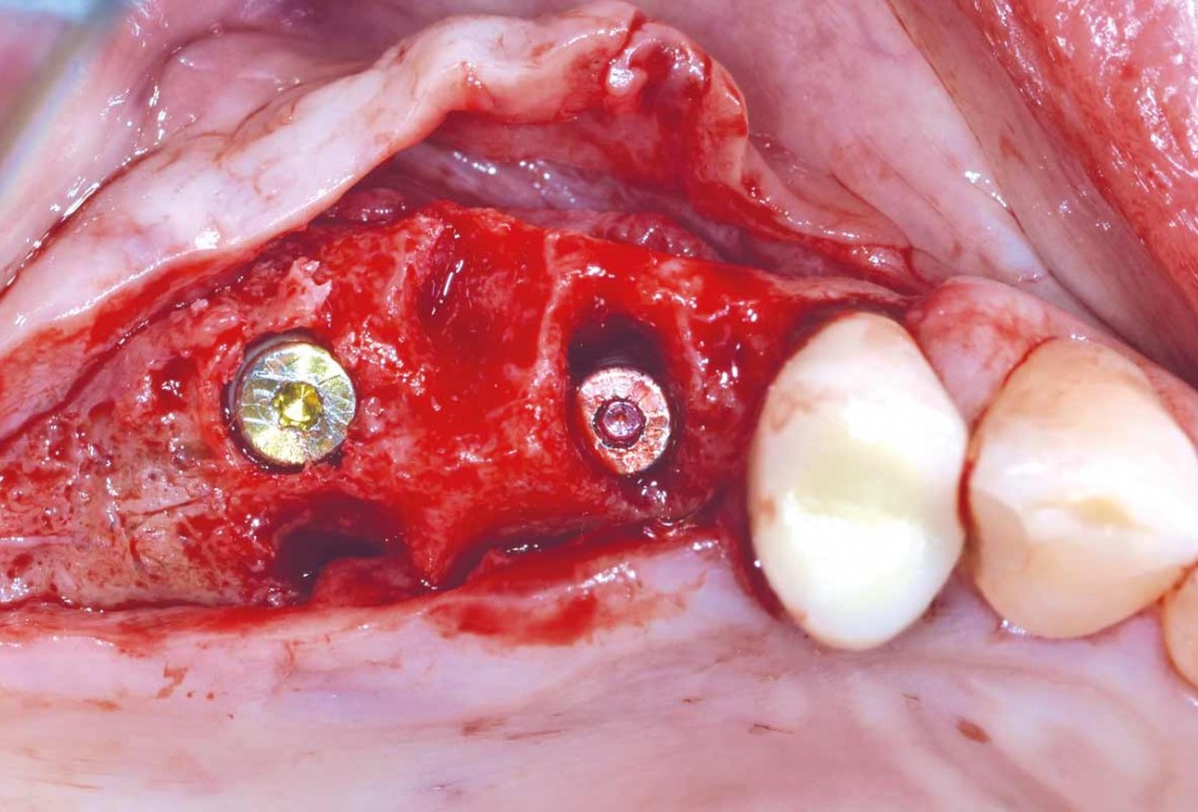 GBR and widening of the keratinized mucosa with mucoderm® - Clinical Case by Dr. M. Blaskovic