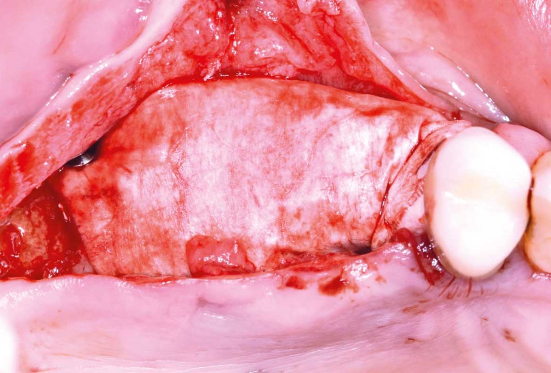 GBR and widening of the keratinized mucosa with mucoderm® - Clinical Case by Dr. M. Blaskovic