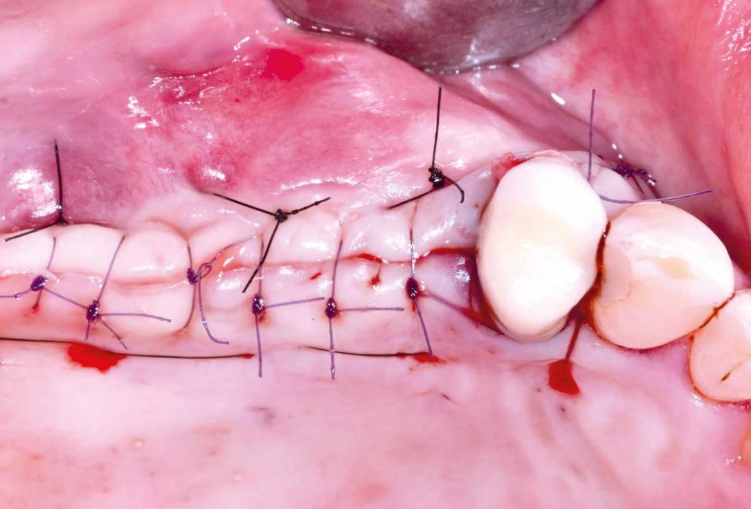 GBR and widening of the keratinized mucosa with mucoderm® - Clinical Case by Dr. M. Blaskovic