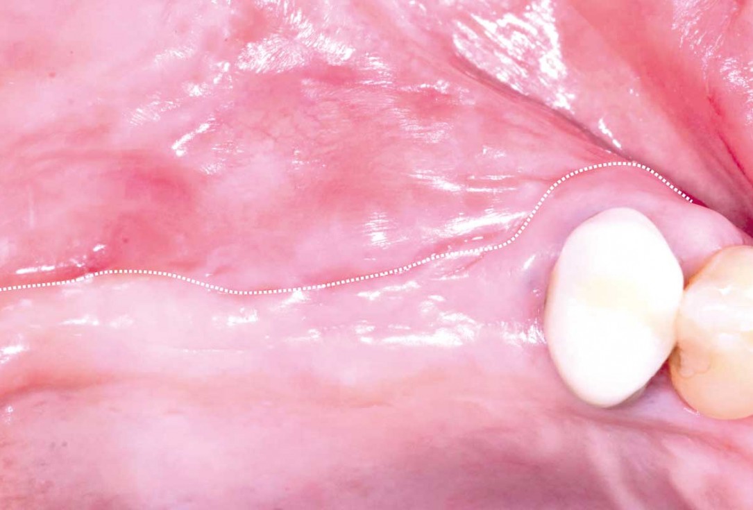 GBR and widening of the keratinized mucosa with mucoderm® - Clinical Case by Dr. M. Blaskovic