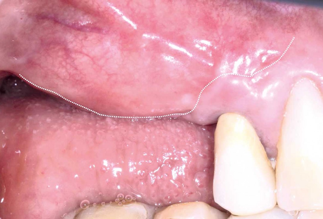 GBR and widening of the keratinized mucosa with mucoderm® - Clinical Case by Dr. M. Blaskovic