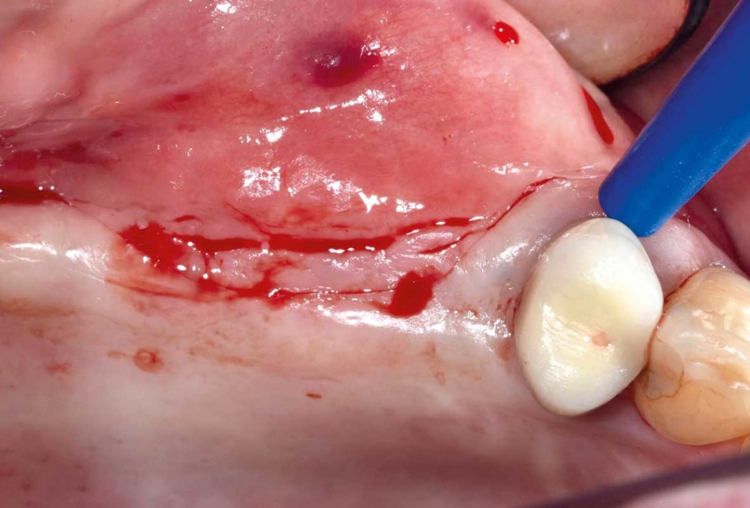 GBR and widening of the keratinized mucosa with mucoderm® - Clinical Case by Dr. M. Blaskovic