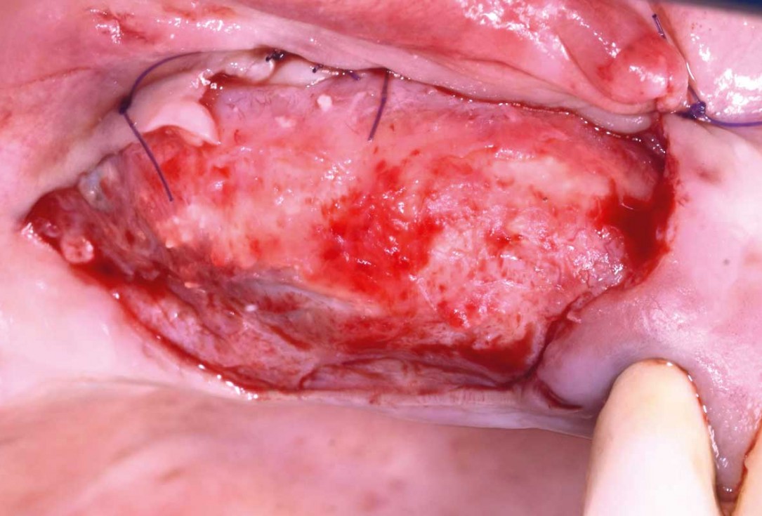 GBR and widening of the keratinized mucosa with mucoderm® - Clinical Case by Dr. M. Blaskovic