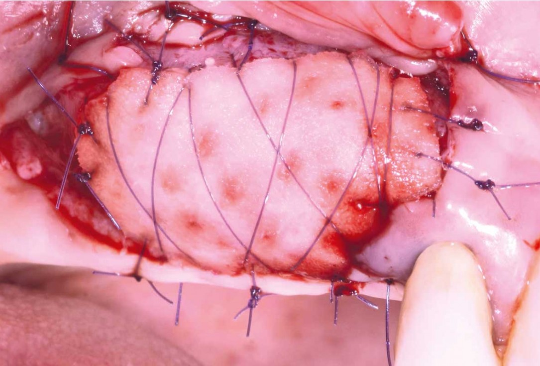 GBR and widening of the keratinized mucosa with mucoderm® - Clinical Case by Dr. M. Blaskovic