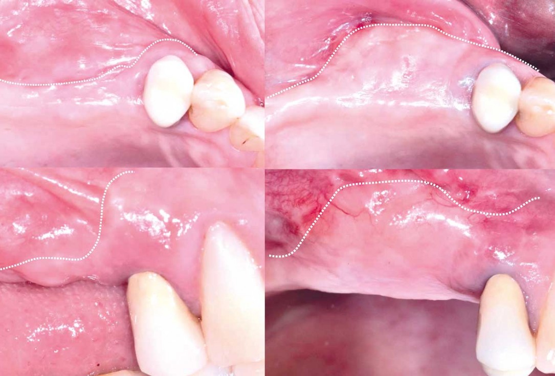 GBR and widening of the keratinized mucosa with mucoderm® - Clinical Case by Dr. M. Blaskovic