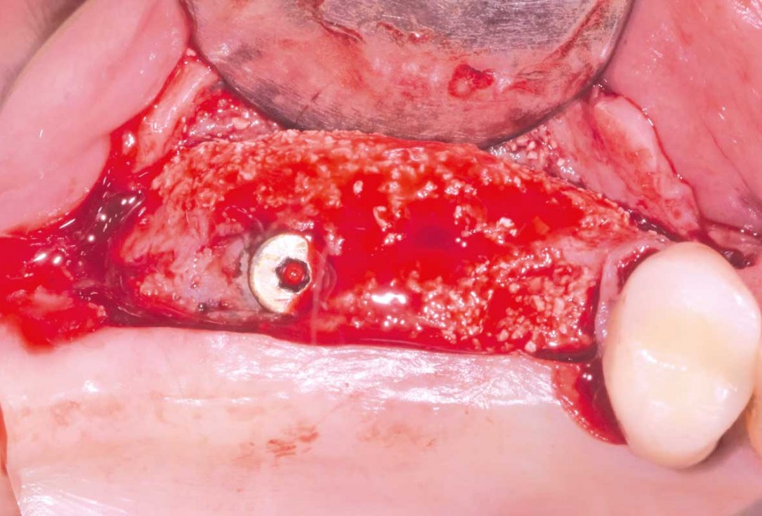 GBR and widening of the keratinized mucosa with mucoderm® - Clinical Case by Dr. M. Blaskovic