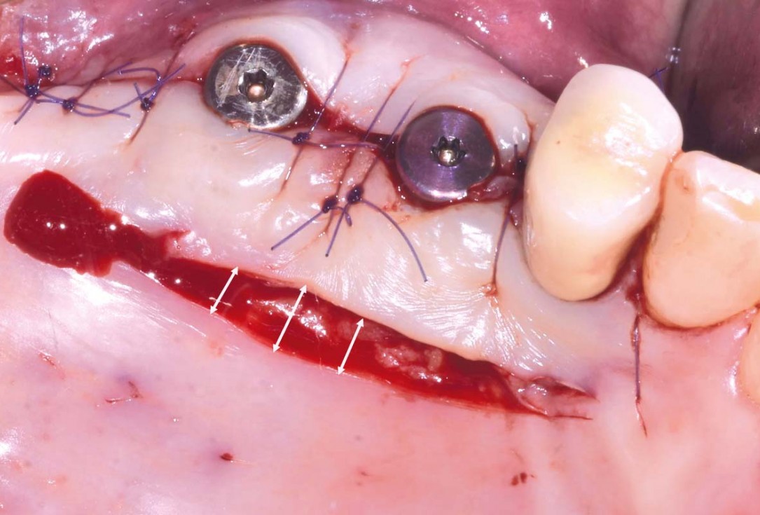 GBR and widening of the keratinized mucosa with mucoderm® - Clinical Case by Dr. M. Blaskovic