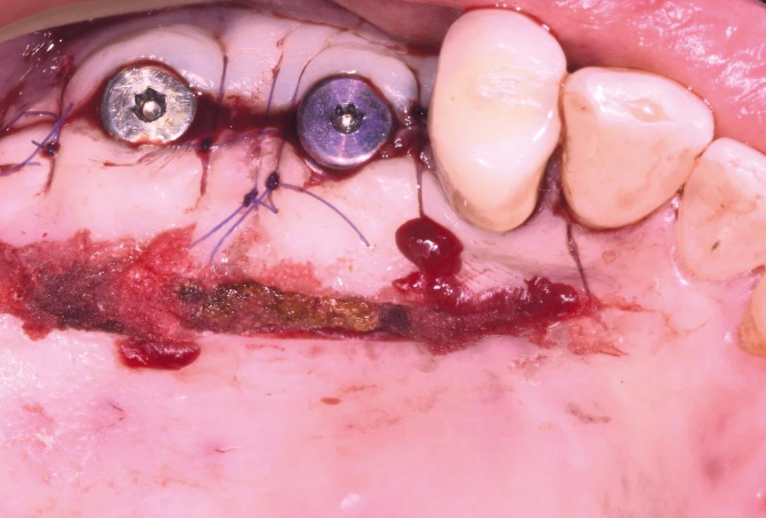 GBR and widening of the keratinized mucosa with mucoderm® - Clinical Case by Dr. M. Blaskovic