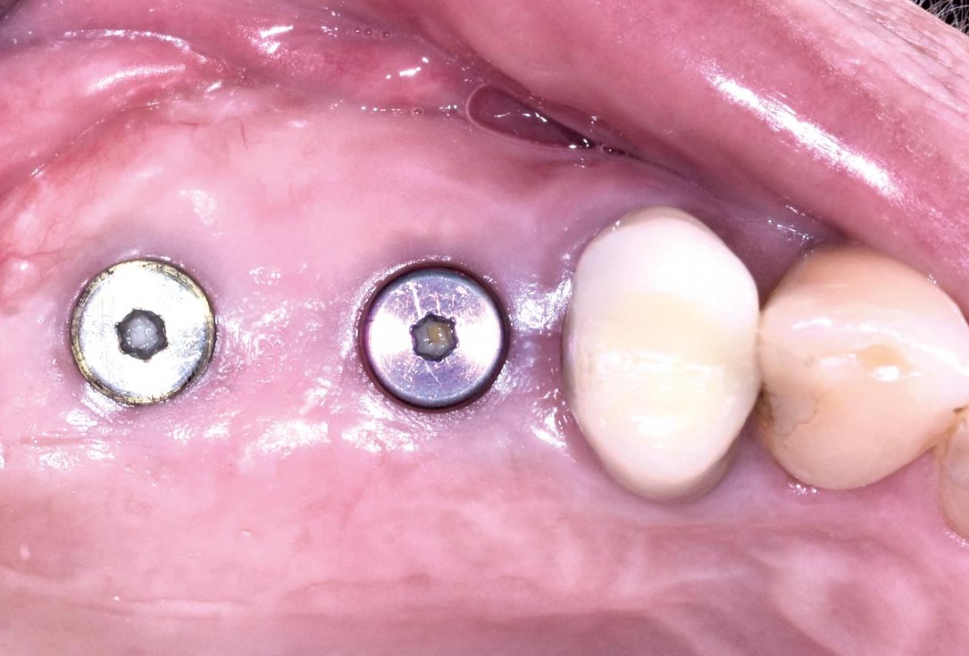 GBR and widening of the keratinized mucosa with mucoderm® - Clinical Case by Dr. M. Blaskovic