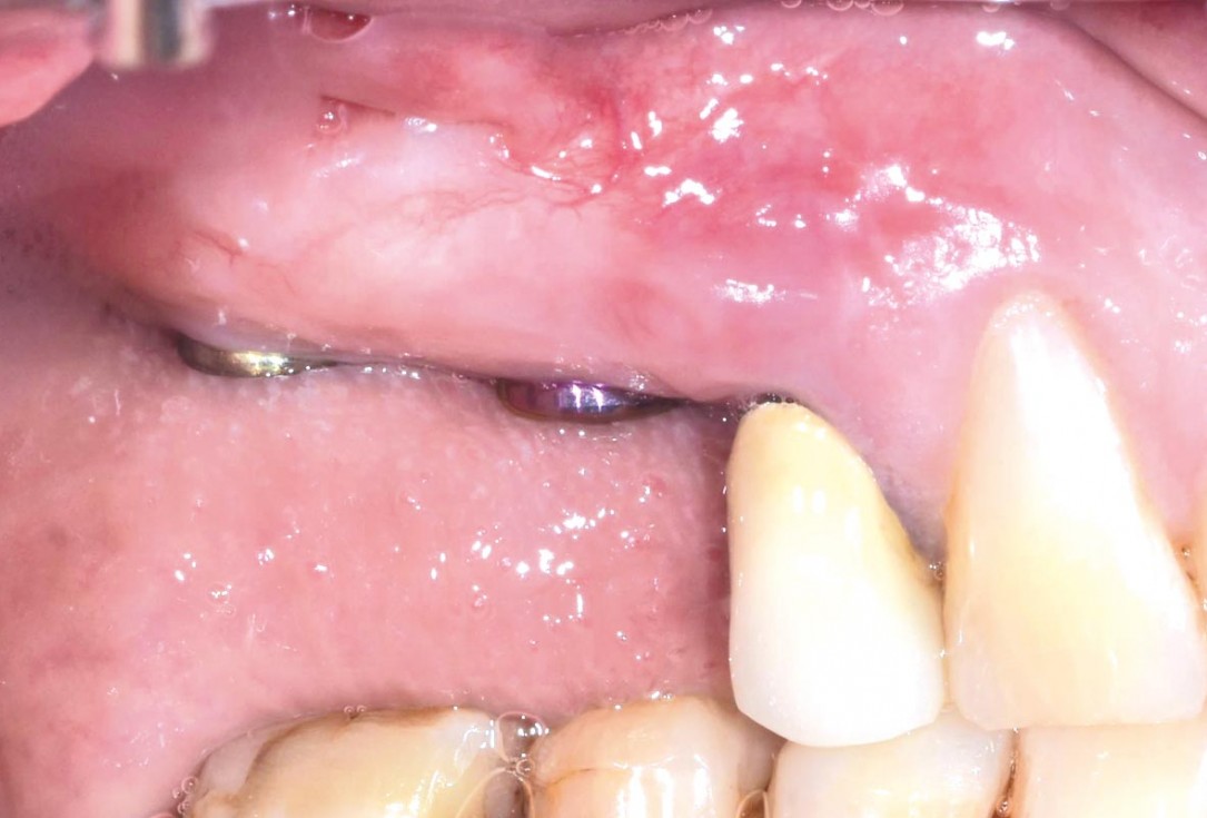 GBR and widening of the keratinized mucosa with mucoderm® - Clinical Case by Dr. M. Blaskovic