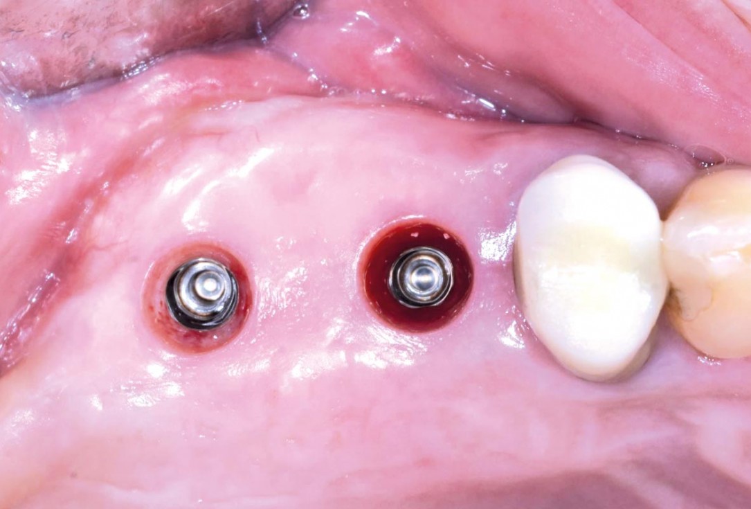 GBR and widening of the keratinized mucosa with mucoderm® - Clinical Case by Dr. M. Blaskovic