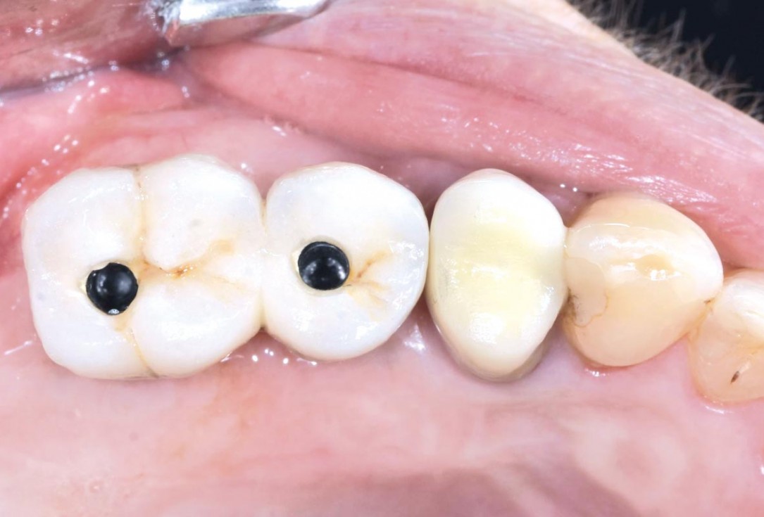 GBR and widening of the keratinized mucosa with mucoderm® - Clinical Case by Dr. M. Blaskovic