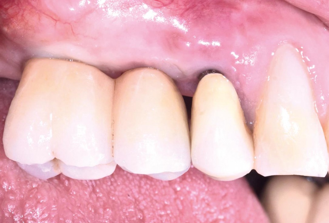 GBR and widening of the keratinized mucosa with mucoderm® - Clinical Case by Dr. M. Blaskovic