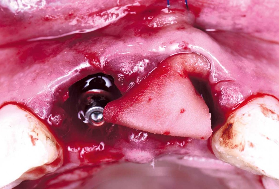 cerabone® and mucoderm® for immediate implantation in the aesthetic area - Dr. D. Robles 