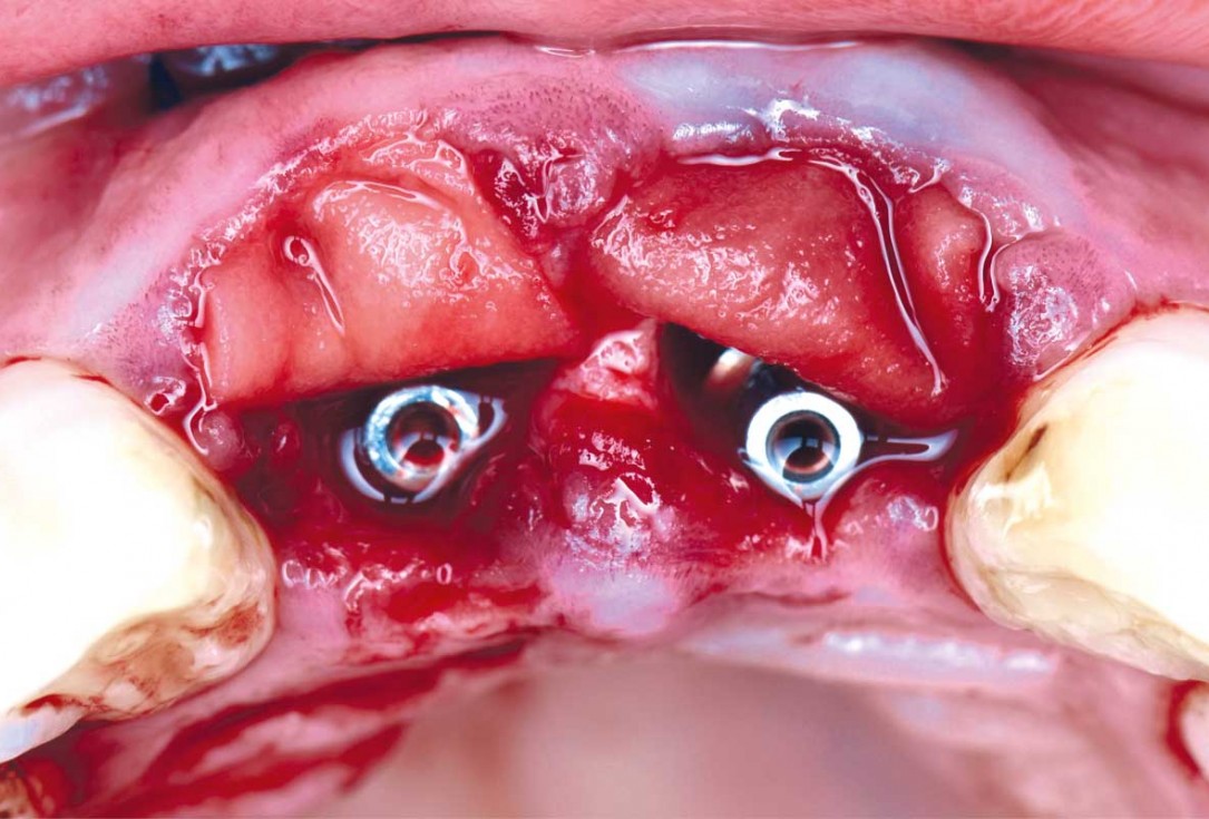 cerabone® and mucoderm® for immediate implantation in the aesthetic area - Dr. D. Robles 