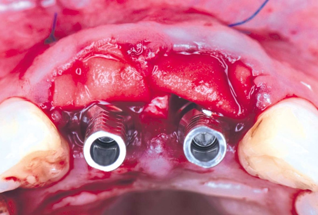 cerabone® and mucoderm® for immediate implantation in the aesthetic area - Dr. D. Robles 
