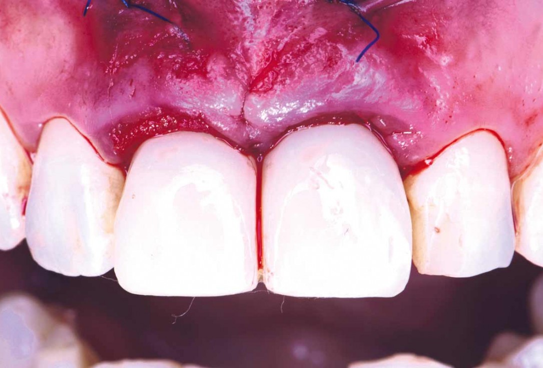 cerabone® and mucoderm® for immediate implantation in the aesthetic area - Dr. D. Robles 